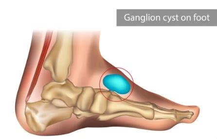 GANGLIONS ON THE FOOT Midwest Orthopaedics