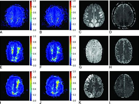 Anoxic Brain Injury Detection With The Normalized Diffusion To Asl