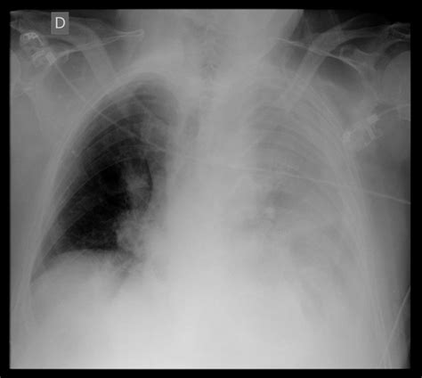 Chest X Ray Showing Homogeneous Opacity In The Left Hemithorax