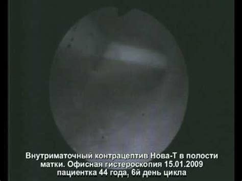 Спираль внутриматочная Нова-Т. Гистерофиброскопия - YouTube