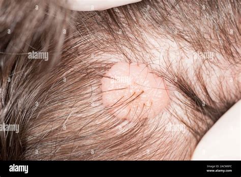 Melanocytic Naevus Mole Of The Scalp Close Up Of A Mole Naevus On