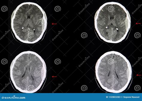 Brain Ct Scan Epidural Hemorrhage Stock Image Image Of Hematoma