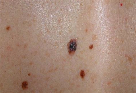 Mole Or Melanoma Test Yourself With These Suspicious Lesions