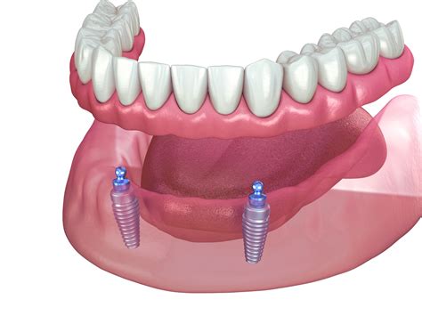 Full Arch Implant Dentures - Denturly