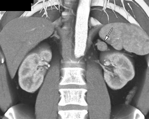 Adrenal Imaging With Multidetector CT Evidence Based Protocol