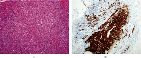 Varying Phenotypes Of Leydig Cell Hyperplasia Of The Ovary Two Case