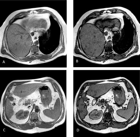 Figure 2 From Multiple Echogenic Liver Masses From Multifocal Nodular