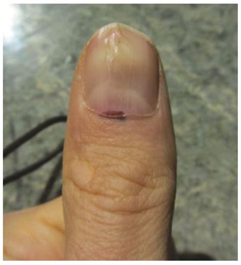 Melanoma Of The Hand Current Practice And New Frontiers