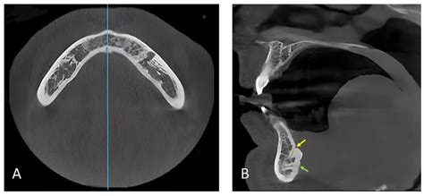 IJERPH Free Full Text Morphometric Analysis Of The Midline