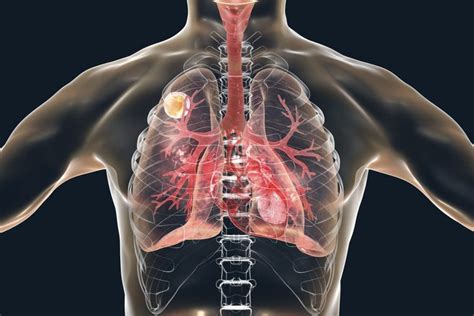 Fungal infections (mycoses) - symptoms, causes and treatment - All My Family Care