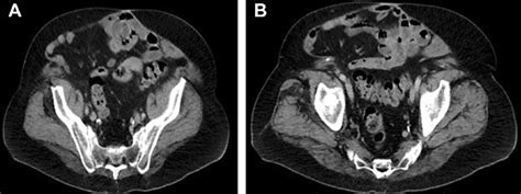 A Transverse Ct Scan Of The Abdominopelvic Region Reveals The