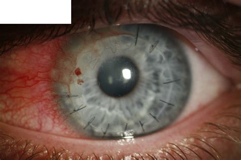 Visible Stitches After A Corneal Transplant R Damnthatsinteresting