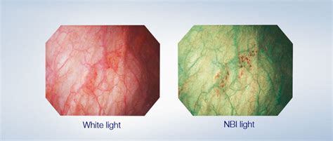 Narrow Band Imaging For Endoscopy Olympus Stories