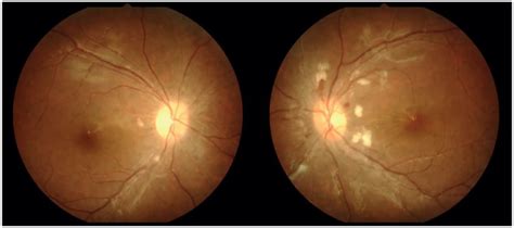 Optic disc photo of both the eyes showing optic disc edema with ...