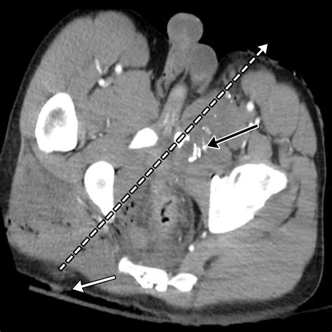Imaging Evaluation of Abdominopelvic Gunshot TraumaRadioGraphics