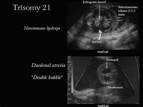 Echogenic Bowel 2 Vessel Cord