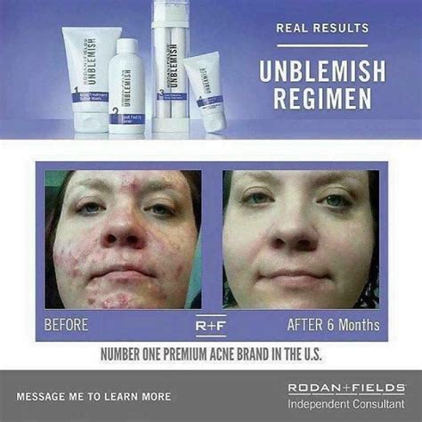 Be Picture Ready With Clear Skin Unblemish Can Help You Achieve That