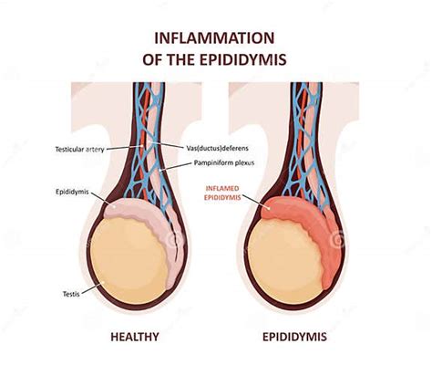 Inflamación Del Epidídimo Comparación Y Diferencia De Testículo Sano Y