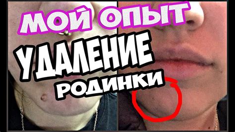УДАЛЕНИЕ РОДИНКИ НА ЛИЦЕ ЛАЗЕРОМ // МОЙ ОПЫТ - YouTube