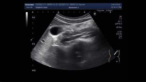 Ultrasound Video Showing Stone And Sludge In Gall Bladder With Large