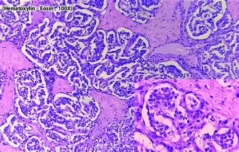 Tumor Cells Arranged In Ball Like Clusters Surrounded By Vascular