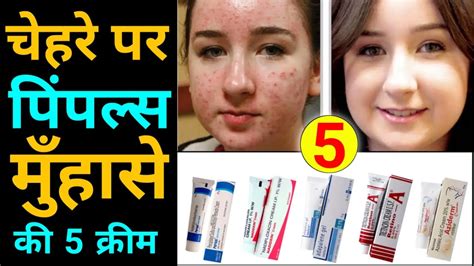 Top Acne Hatane Ki Cream Best Cream For Pimples Dark Spots And Acne