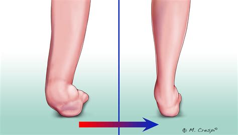 Charcot Surgical Reconstruction Orthofix