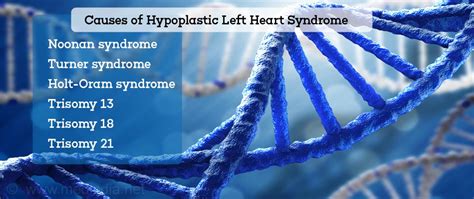 Hypoplastic Left Heart Syndrome - Causes, Symptoms, Diagnosis & Treatment