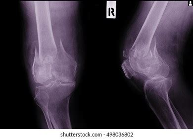 Xray Knee Join Showing Large Osteolytic Foto Stock