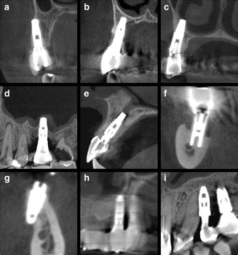 Cortical Plate Dental