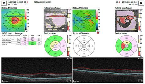 Optical coherence tomography (OCT) scan pre- and post-injection of... | Download Scientific Diagram