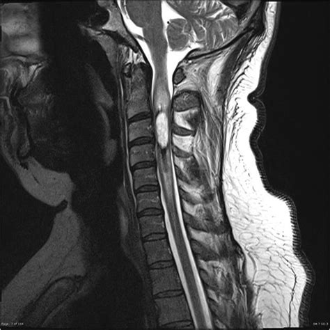 Spinal Cord Lesions Artofit Hot Sex Picture