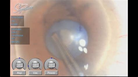 Phacoemulsification In Narrow Pupil And Hard Nuclear Cataract YouTube