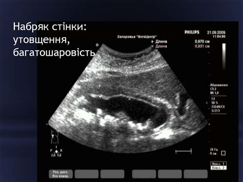 Променеве дослідження гепатопанкреатобіліарної системи і селезінки ...