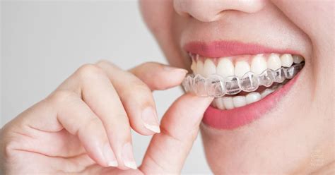 Usar Invisalign Con Carillas Dentales Sof A Cort S Cl Nica Dental