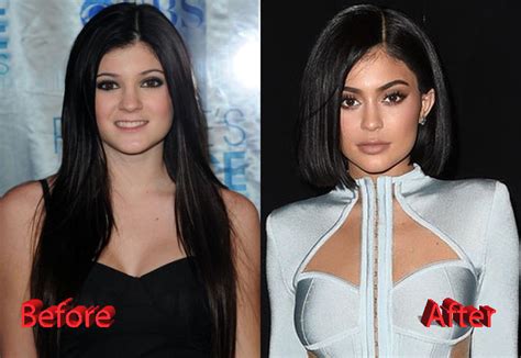 Kylie Jenner Plastic Surgery Facts Rumors And News