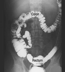 Barium enema Guide: Causes, Symptoms and Treatment Options