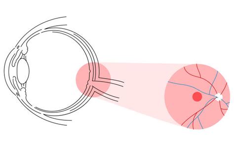 degenerasi makula ilustrasi foto stok potret gambar bebas