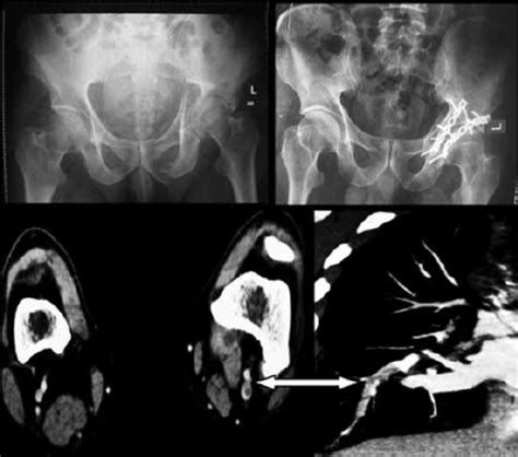 A 21 Year Old Man With A Transverse Acetabular Fracture And Vertically