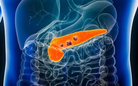 Noxopharm Granted Fda Orphan Drug Status For Cro 67 To Treat Pancreatic Cancer