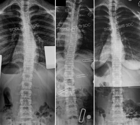 Risser 1 | What is Risser 1 | Risser 1 Scoliosis Treatment