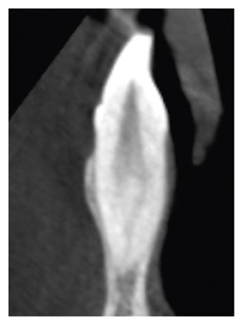 Sagittal Cbct Sections Of Mandibular Incisors Show A One Canal With