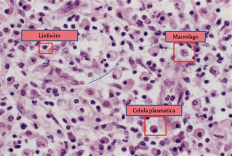 Teoria Inflamaci N Cronica Quizlet