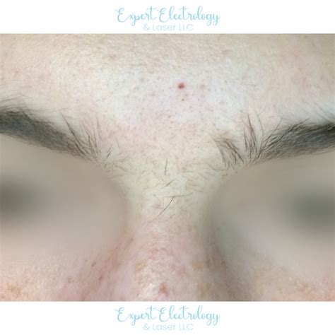 Electrolysis Results - Expert Electrology