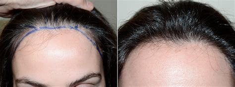 29+ Hair Transplant For Women - OmereOluyemi