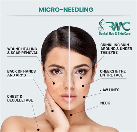 Micro Needling Treatment In Islamabad Rehman Medical Center