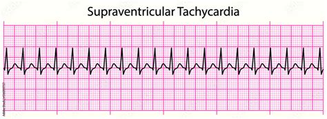 Ekg Strip Search Supraventricular Tachycardia Svt Ekg Svt Heart Images