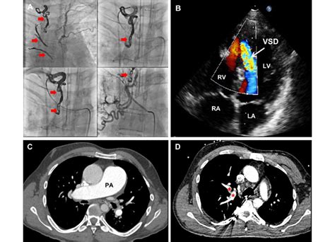 A Successful Angiographic Embolization Of Three Right Main