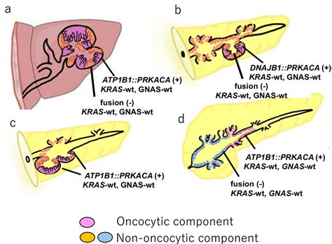 Schematic View Of The Combined Intraductal Oncocytic Papillary Neoplasm