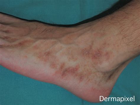 Dermapixel Vasculopat A Livedoide No Es Una Vasculitis